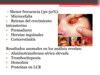 • Menor frecuencia (30-50%):
• Microcefalia
• Retraso del crecimiento
intrauterino
• Premadurez
• Hernias inguinales
• Coriorretinitis
Resultados anomales en los análisis revelan:
• Alaninotransferasa sérica elevada
• Trombocitopenia
• Hemolisis
• Proteínas en LCR
 
