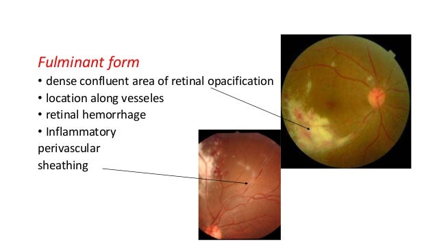 normal retina vs cmv retinitis normal retina vs cmv retinitis
