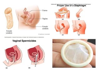 Cn – 9º  Ano (ContracepçãO)