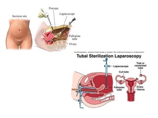 Cn – 9º  Ano (ContracepçãO)