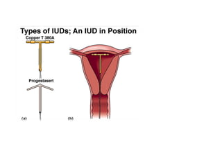 Cn – 9º  Ano (ContracepçãO)