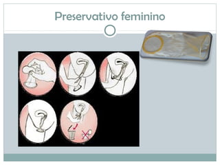 Preservativo feminino
 