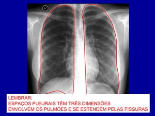 LEMBRAR:
ESPAÇOS PLEURAIS TÊM TRÊS DIMENSÕES
ENVOLVEM OS PULMÕES E SE ESTENDEM PELAS FISSURAS
 