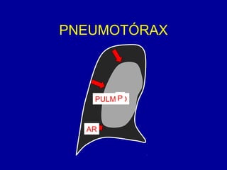PNEUMOTÓRAX
PULMÃOP
AR
 