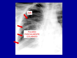 AR
PULMÃO
PARCIALMENTE
COLABADO
 