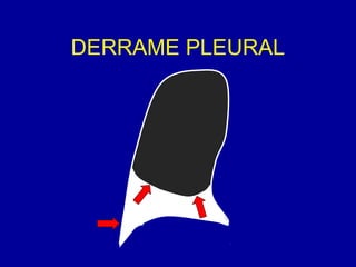 DERRAME PLEURAL
 