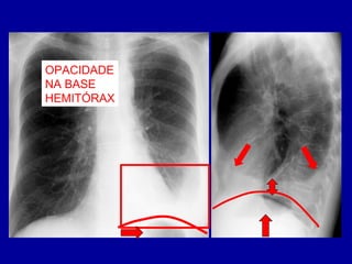 OPACIDADE
NA BASE
HEMITÓRAX
 
