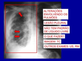 LESÃO PLEURAL
NÃO TEM PADRÃO
DE LÍQUIDO LIVRE
ALTERAÇÕES
ENVOLVENDO OS
PULMÕES
O QUE FAZER?
IMAGEM: TC
OUTROS EXAMES: US, RM
 
