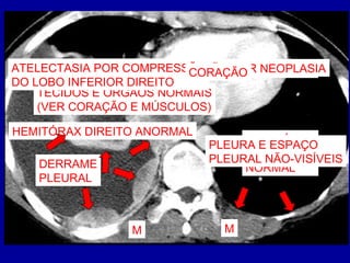 HEMITÓRAX
ESQUERDO
NORMAL
PULMÃO AERADO
PLEURA E ESPAÇO
PLEURAL NÃO-VISÍVEIS
TC MOSTRA DENSIDADES QUE RX NÃO MOSTRA
TECIDOS E ÓRGÃOS NORMAIS
(VER CORAÇÃO E MÚSCULOS)
HEMITÓRAX DIREITO ANORMAL
DERRAME
PLEURAL
NÓDULOS PLEURAIS = INFILTRAÇÃO POR NEOPLASIAATELECTASIA POR COMPRESSÃO
DO LOBO INFERIOR DIREITO
M M
CORAÇÃO
 