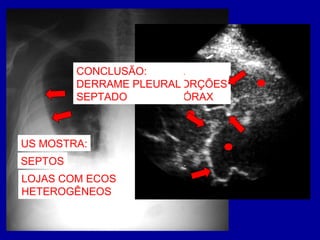 DERRAME PLEURAL
BILATERAL
US MOSTRA:
DERRAME À DIREITA
ACUMULA-SE NAS PORÇÕES
LATERAIS DO HEMITÓRAX
CONCLUSÃO:
DERRAME PLEURAL
SEPTADO
SEPTOS
LOJAS COM ECOS
HETEROGÊNEOS
 