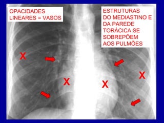 OPACIDADES
LINEARES = VASOS
ESTRUTURAS
DO MEDIASTINO E
DA PAREDE
TORÁCICA SE
SOBREPÕEM
AOS PULMÕES
XX
X
X
 