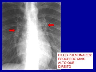 HILOS PULMONARES:
ESQUERDO MAIS
ALTO QUE
DIREITO
 