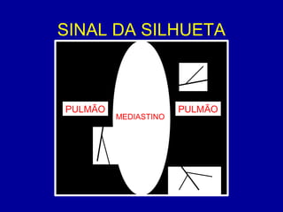 SINAL DA SILHUETA
PULMÃO PULMÃO
MEDIASTINO
 