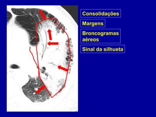 Broncogramas
aéreos
Margens
Consolidações
Sinal da silhueta
 