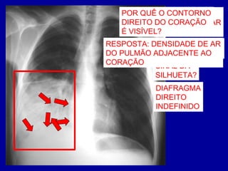 BRONCOGRAMAS
AÉREOS
OPACIDADE
BASE PULMONAR
DIREITA
SINAL DA
SILHUETA?
POR QUÊ O CONTORNO
DIREITO DO CORAÇÃO
É VISÍVEL?
DIAFRAGMA
DIREITO
INDEFINIDO
RESPOSTA: DENSIDADE DE AR
DO PULMÃO ADJACENTE AO
CORAÇÃO
 