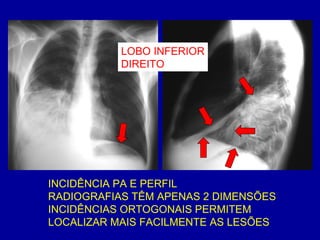 INCIDÊNCIA PA E PERFIL
RADIOGRAFIAS TÊM APENAS 2 DIMENSÕES
INCIDÊNCIAS ORTOGONAIS PERMITEM
LOCALIZAR MAIS FACILMENTE AS LESÕES
LOBO INFERIOR
DIREITO
 