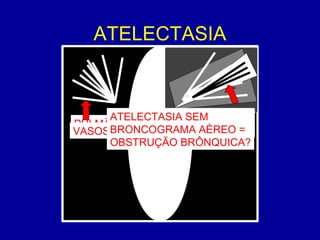 ATELECTASIA
PULMÃO PULMÃO
MEDIASTINOVASOS
BRONCOGRAMAS
AÉREOS
ATELECTASIA SEM
BRONCOGRAMA AÉREO =
OBSTRUÇÃO BRÔNQUICA?
 