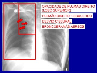 BRONCOBRAMAS AÉREOS
PULMÃO DIREITO < ESQUERDO
OPACIDADE DE PULMÃO DIREITO
(LOBO SUPERIOR)
DESVIO CISSURAL
 
