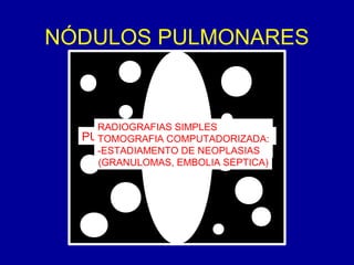 NÓDULOS PULMONARES
PULMÃO PULMÃO
MEDIASTINO
MÚLTIPLOS NÓDULOS:
-NEOPLASIA METASTÁTICA
-PROCESSOS INFECCIOSOS
(GRANULOMAS, EMBOLIA SÉPTICA)
RADIOGRAFIAS SIMPLES
TOMOGRAFIA COMPUTADORIZADA:
-ESTADIAMENTO DE NEOPLASIAS
 