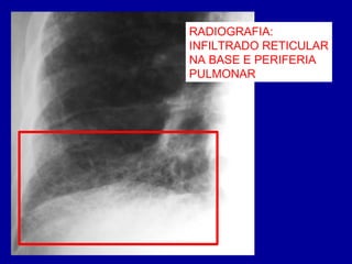 RADIOGRAFIA:
INFILTRADO RETICULAR
NA BASE E PERIFERIA
PULMONAR
 