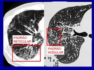 PADRÃO
RETICULAR
PADRÃO
NODULAR
 