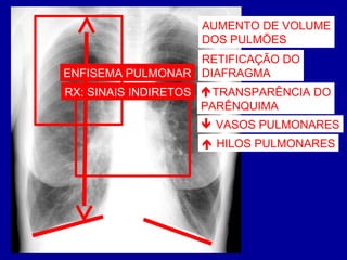 AUMENTO DE VOLUME
DOS PULMÕES
RETIFICAÇÃO DO
DIAFRAGMA
TRANSPARÊNCIA DO
PARÊNQUIMA
 HILOS PULMONARES
 VASOS PULMONARES
ENFISEMA PULMONAR
RX: SINAIS INDIRETOS
 