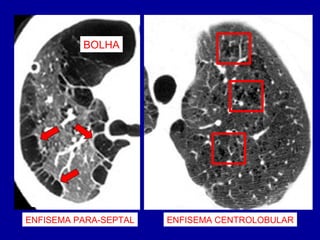 BOLHA
ENFISEMA PARA-SEPTAL ENFISEMA CENTROLOBULAR
 