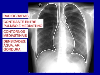 RADIOGRAFIAS
CONTRASTE ENTRE
PULMÃO E MEDIASTINO
CONTORNOS
MEDIASTINAIS
DENSIDADES:
ÁGUA, AR,
GORDURA
 