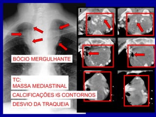 MASSA MEDIASTINAL
ALTERAÇÕES DOS CONTORNOS
DESVIO DA TRAQUEIA
TC:
MASSA MEDIASTINAL
CALCIFICAÇÕES
BÓCIO MERGULHANTE
 