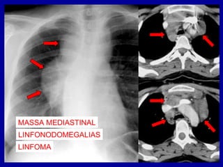 MASSA MEDIASTINAL
LINFONODOMEGALIAS
LINFOMA
 