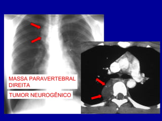 MASSA PARAVERTEBRAL
DIREITA
TUMOR NEUROGÊNICO
 
