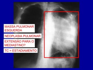 MASSA PULMONAR
ESQUERDA
NEOPLASIA PULMONAR
EXTENSÃO PARA O
MEDIASTINO?
TC = ESTADIAMENTO
 
