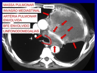 MASSA PULMONAR
INVASÃO MEDIASTINAL
ARTÉRIA PULMONAR
ENVOLVIDA
BFE ENVOLVIDO
LINFONODOMEGALIAS
 