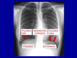 PULMÃO
DIR.
PULMÃO
ESQ.
MEDIASTINO
CORAÇÃO
FÍGADO ESTÔMAGO
 