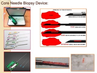 cnbbreast-Core needle biopsy of breast : practical issues and updates | PDF