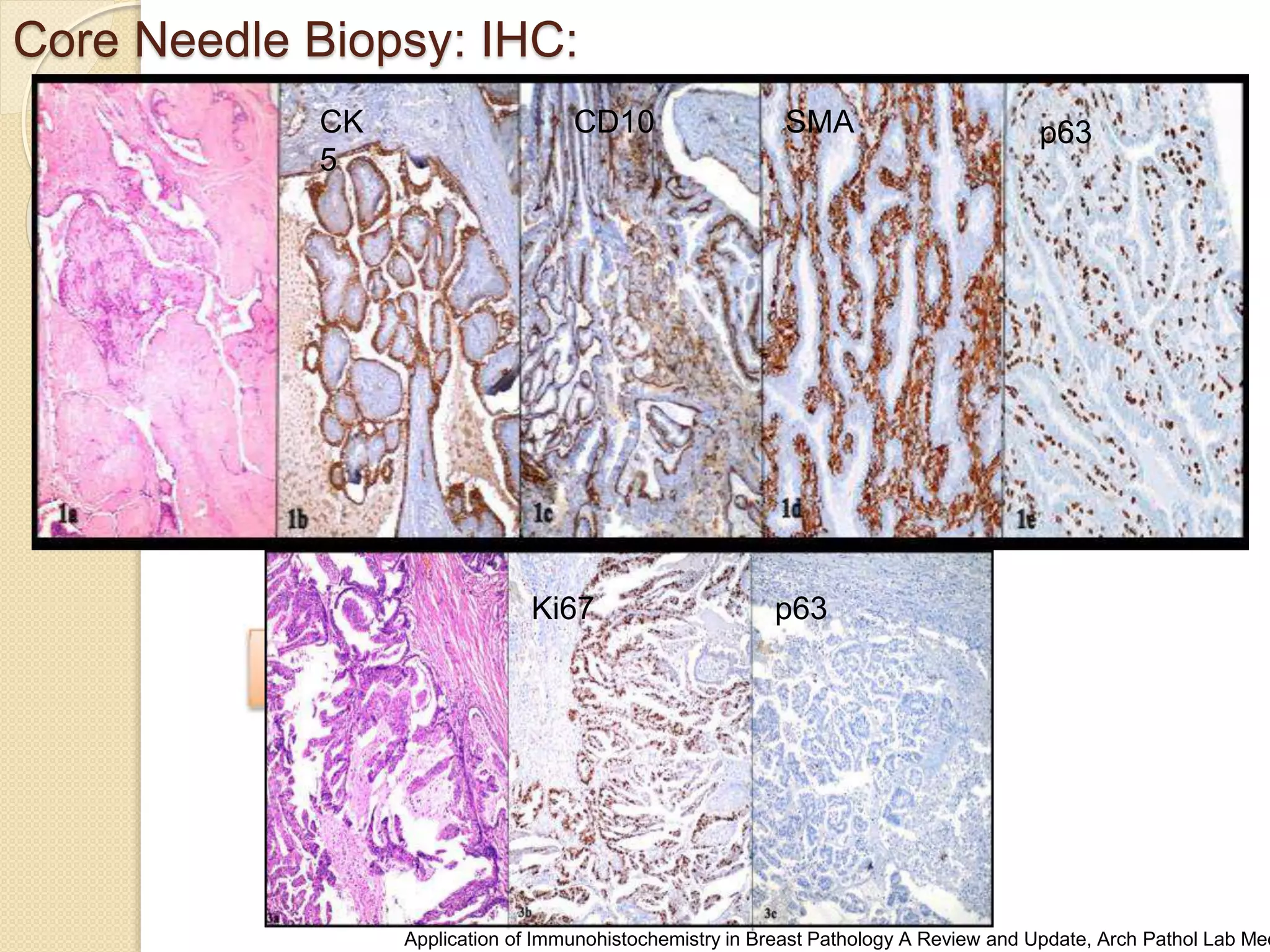 Core Needle Biopsy of Breast : Updates | PPTX