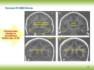 Relatively	preserved
hippocampal	complex
Global
atrophy
Posterior											parietal	cuts	
Dramatic	bilateral																																											superior	parietal	atrophy
Coronal T1 MRI Brain
Parietal lobe
atrophy is
exceptional
before age of 65
33
 