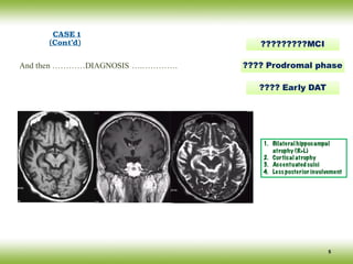 And then …………DIAGNOSIS ….………….
?????????MCI
5
???? Prodromal phase
???? Early DAT
CASE 1
(Cont’d)
1. Bilateral hippocampal
atrophy (R>L)
2. Cortical atrophy
3. Accentuated sulci
4. Less posterior involvement
 