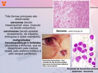 Três formas principais são observadas:  sarcomas  (tecido mesenquimal: osso, músculo ou tecido conjuntivo) carcinomas  (tecido epitelial: revestimento, do intestino, brônquios e dutos mamários)  malignidades hematopoiéticas e linfóides  (leucemias e linfomas, que se disseminam pela medula óssea, pelo sistema linfático e pelo sangue periférico)  Sarcoma  – www.inca.gov.br Acúmulo de leucócitos jovens anormais - leucemia 