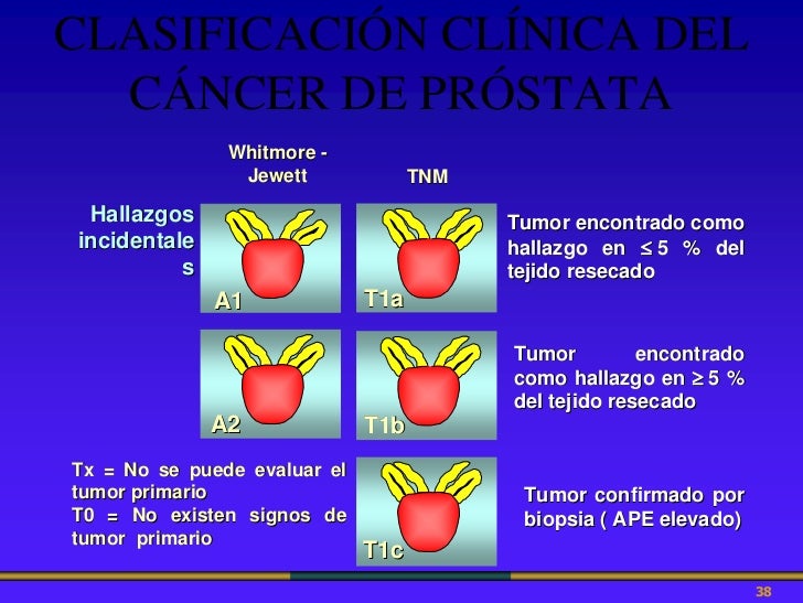 Cáncer De Próstata