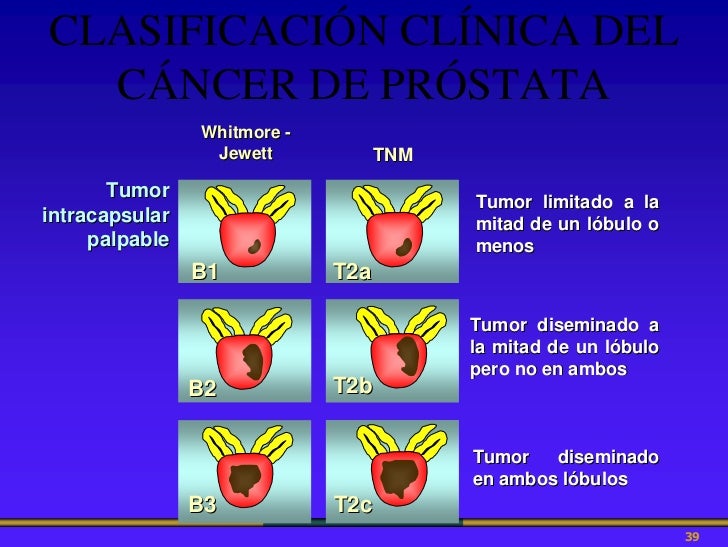 Cáncer De Próstata