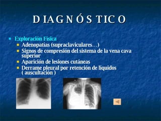 DIAGNÓSTICO Exploración Física : Adenopatías (supraclaviculares…) Signos de compresión del sistema de la vena cava superior Aparición de lesiones cutáneas Derrame pleural por retención de líquidos  ( auscultación ) 