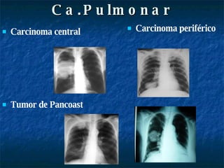 Ca.Pulmonar Carcinoma central Tumor de Pancoast Carcinoma periférico 
