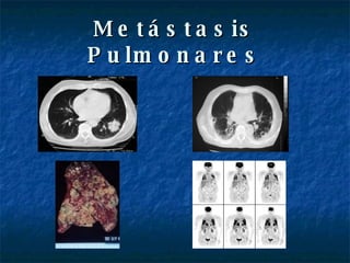 Metástasis Pulmonares 