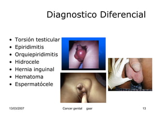 Cáncer Genital
