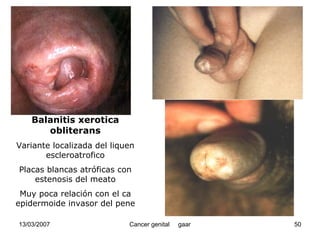 Cáncer Genital
