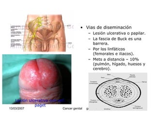 Cáncer Genital