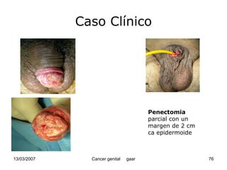 Cáncer Genital