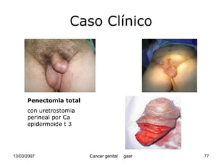 Cáncer Genital