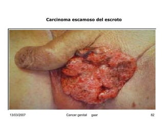 Cáncer Genital